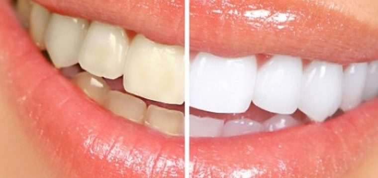 Como mejorar tu higiene dental de forma natural