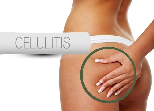 Que es y como reducir la celulitis Que es y como reducir la celulitis