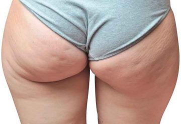 Te puede Interesar: Qué es y cómo reducir la celulitis