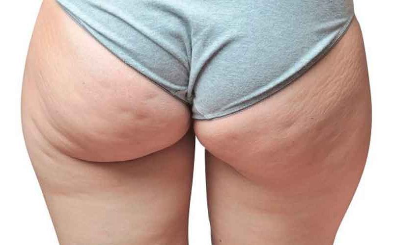 Qué es y cómo reducir la celulitis Qué es y cómo reducir la celulitis